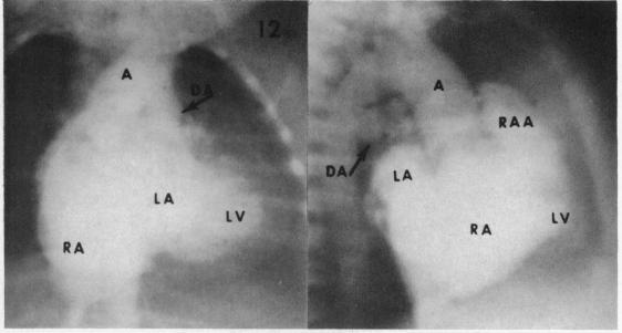 https://cdn.ncbi.nlm.nih.gov/pmc/blobs/06b9/1018047/c9ead44bcab4/brheartj00352-0112-a.jpg