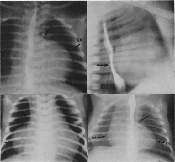 https://cdn.ncbi.nlm.nih.gov/pmc/blobs/06b9/1018047/cdfde533635b/brheartj00352-0108-a.jpg