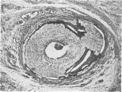 https://cdn.ncbi.nlm.nih.gov/pmc/blobs/06c2/1648741/76713c39e948/archdisch00856-0010-b.jpg