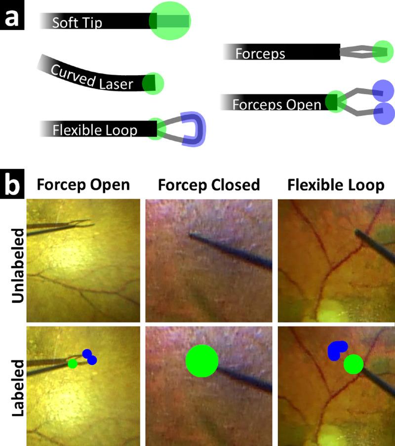 https://cdn.ncbi.nlm.nih.gov/pmc/blobs/0750/9851279/9443cbe9b73f/tvst-12-1-20-f002.jpg