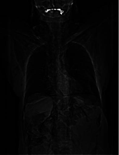 https://cdn.ncbi.nlm.nih.gov/pmc/blobs/0763/11219207/e236814e5308/CRIGM2024-1140099.004.jpg