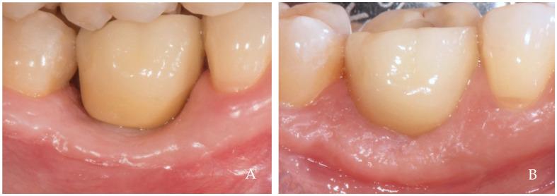 https://cdn.ncbi.nlm.nih.gov/pmc/blobs/07d5/11275616/05dd7e5b760d/dentistry-12-00216-g004.jpg