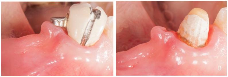 https://cdn.ncbi.nlm.nih.gov/pmc/blobs/07d5/11275616/6c4d22690c3d/dentistry-12-00216-g010.jpg