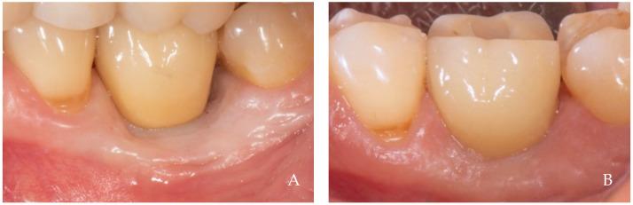 https://cdn.ncbi.nlm.nih.gov/pmc/blobs/07d5/11275616/c5b9bae94a0f/dentistry-12-00216-g005.jpg