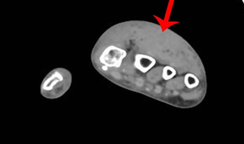 https://cdn.ncbi.nlm.nih.gov/pmc/blobs/07d8/6411332/ece8b96b0028/cureus-0011-00000003845-i02.jpg