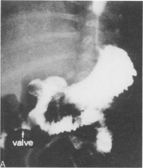 https://cdn.ncbi.nlm.nih.gov/pmc/blobs/083f/1358333/4d1f4c18b78d/annsurg00157-0073-a.jpg