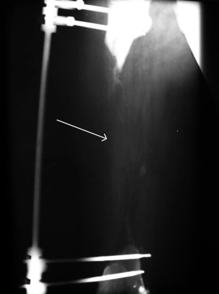 https://cdn.ncbi.nlm.nih.gov/pmc/blobs/0861/12065977/ef1e50526547/cureus-0017-00000082000-i01.jpg
