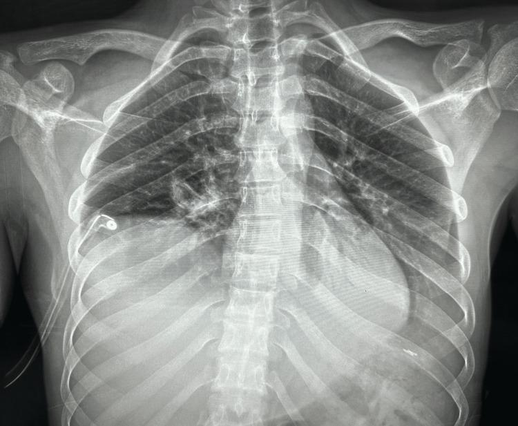 https://cdn.ncbi.nlm.nih.gov/pmc/blobs/0872/10369083/357e01b475ec/cureus-0015-00000040959-i06.jpg
