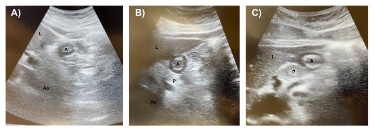 https://cdn.ncbi.nlm.nih.gov/pmc/blobs/0875/12254052/4a13de7b7e5d/cureus-0017-00000085791-i02.jpg