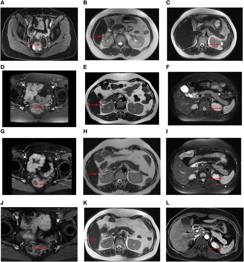 https://cdn.ncbi.nlm.nih.gov/pmc/blobs/08a3/12404960/0f6cac189dbc/fonc-15-1582701-g001.jpg