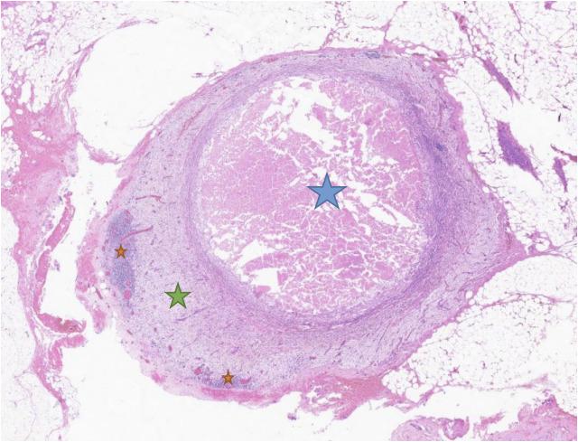 https://cdn.ncbi.nlm.nih.gov/pmc/blobs/08bf/11614720/a7648feb8f6c/fonc-14-1440046-g005.jpg