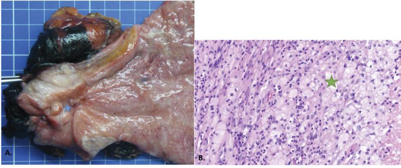 https://cdn.ncbi.nlm.nih.gov/pmc/blobs/08bf/11614720/c853f200b084/fonc-14-1440046-g004.jpg