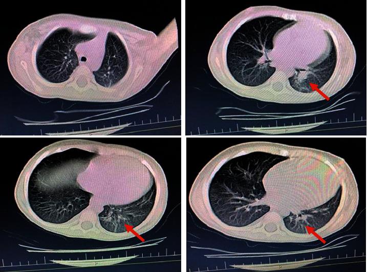 https://cdn.ncbi.nlm.nih.gov/pmc/blobs/08fb/8014250/504c28daa24f/CRIID2021-6629966.001.jpg