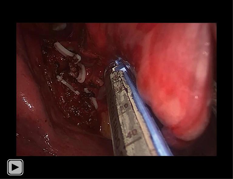 https://cdn.ncbi.nlm.nih.gov/pmc/blobs/0903/10483087/989e91b70525/tlcr-12-08-1728-vid1.jpg