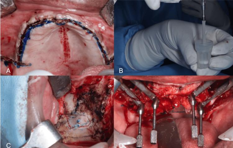 https://cdn.ncbi.nlm.nih.gov/pmc/blobs/096a/11316677/d96801c41812/cureus-0016-00000064280-i01.jpg