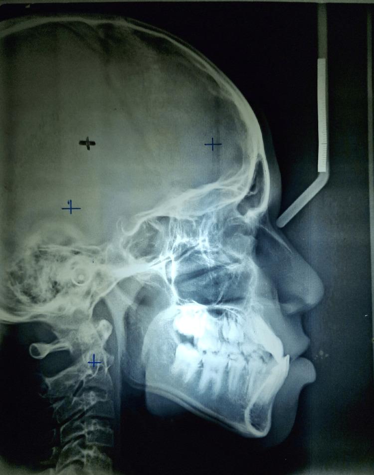 https://cdn.ncbi.nlm.nih.gov/pmc/blobs/097a/11251932/802db2dd724b/cureus-0016-00000062473-i04.jpg