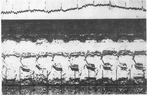 https://cdn.ncbi.nlm.nih.gov/pmc/blobs/0992/287686/40db048a55a5/cardiodis00020-0047-a.jpg