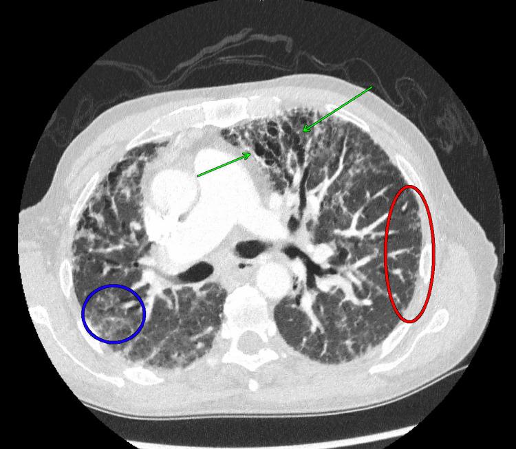 https://cdn.ncbi.nlm.nih.gov/pmc/blobs/09f7/10519440/86ffadd14d0f/cureus-0015-00000044170-i02.jpg