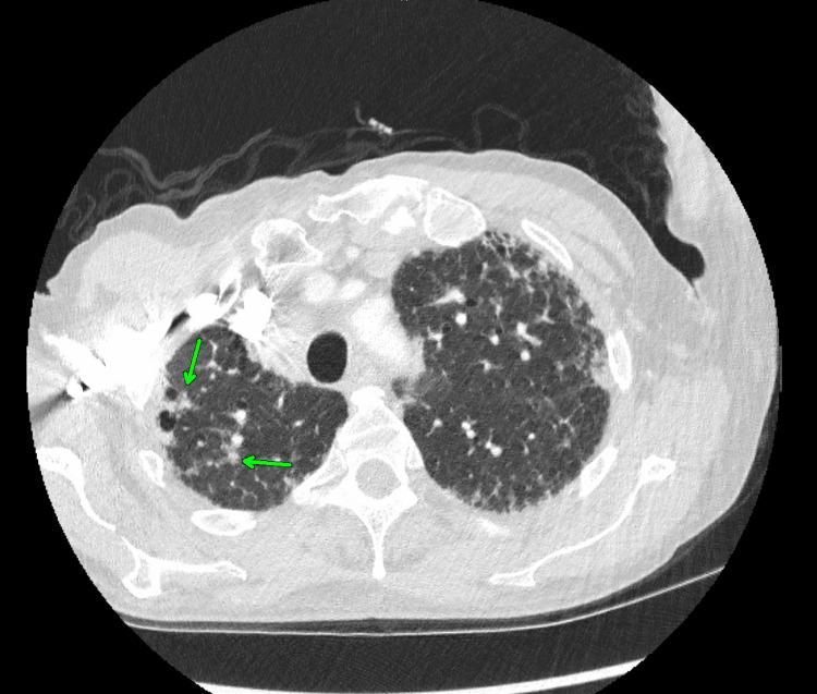 https://cdn.ncbi.nlm.nih.gov/pmc/blobs/09f7/10519440/9fd9ff27be68/cureus-0015-00000044170-i03.jpg