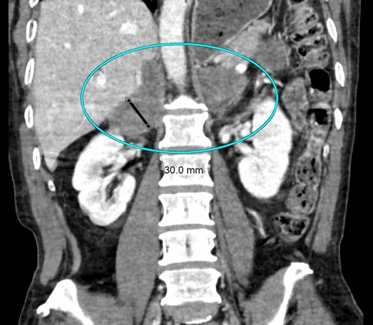 https://cdn.ncbi.nlm.nih.gov/pmc/blobs/09f7/10519440/eb889fb7b3b6/cureus-0015-00000044170-i01.jpg