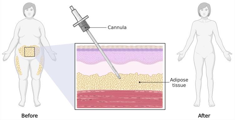 https://cdn.ncbi.nlm.nih.gov/pmc/blobs/09fa/12375336/27bc00bb5017/cureus-0017-00000088737-i04.jpg