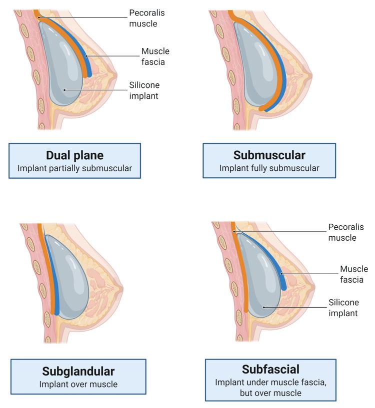 https://cdn.ncbi.nlm.nih.gov/pmc/blobs/09fa/12375336/4214af56e180/cureus-0017-00000088737-i03.jpg