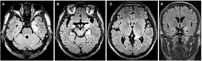 https://cdn.ncbi.nlm.nih.gov/pmc/blobs/0a15/7214674/dbedc3a63285/fneur-11-00280-g0004.jpg