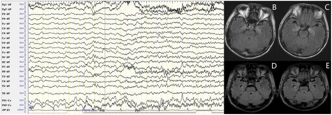 https://cdn.ncbi.nlm.nih.gov/pmc/blobs/0a15/7214674/f5e8e9907d8f/fneur-11-00280-g0001.jpg