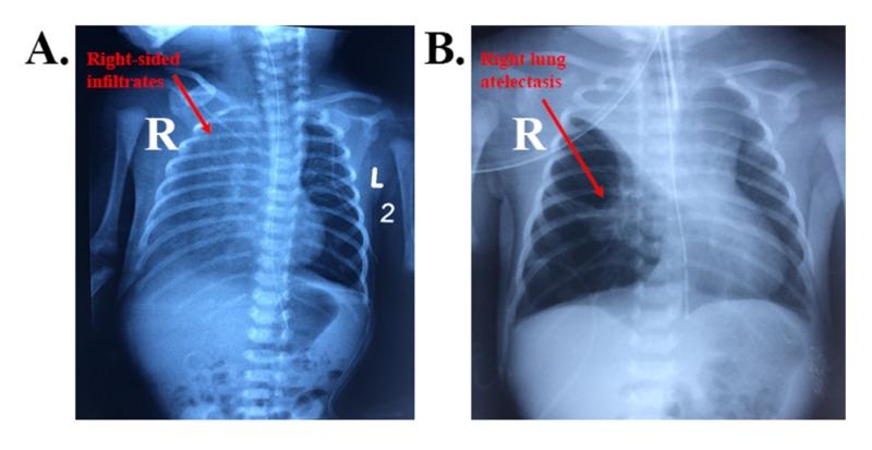 https://cdn.ncbi.nlm.nih.gov/pmc/blobs/0a28/7058402/e212a5f4393f/cureus-0012-00000006889-i01.jpg