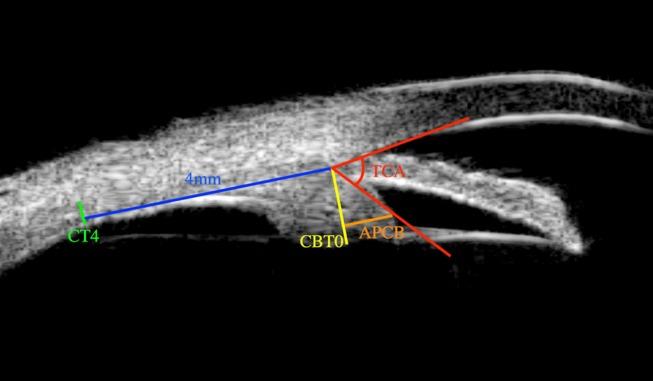 https://cdn.ncbi.nlm.nih.gov/pmc/blobs/0a2c/5754877/a1cf7077d09e/bjophthalmol-2016-309881f02.jpg