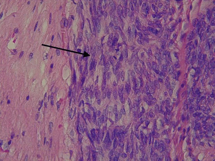 https://cdn.ncbi.nlm.nih.gov/pmc/blobs/0a86/12262156/4d5e3bb37c8d/cureus-0017-00000086066-i04.jpg
