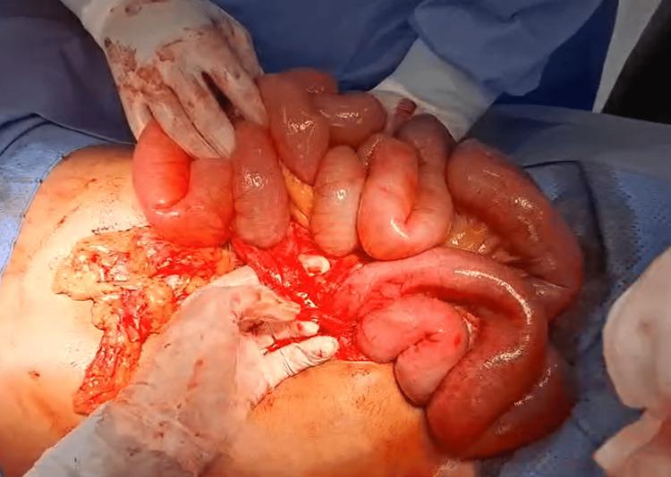 https://cdn.ncbi.nlm.nih.gov/pmc/blobs/0a90/12137200/cb1ba1be8427/cureus-0017-00000083540-i05.jpg