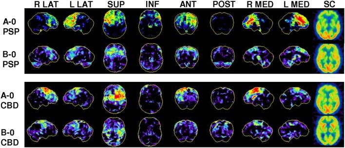 https://cdn.ncbi.nlm.nih.gov/pmc/blobs/0a9f/6019471/b175596c7845/fneur-09-00483-g0001.jpg