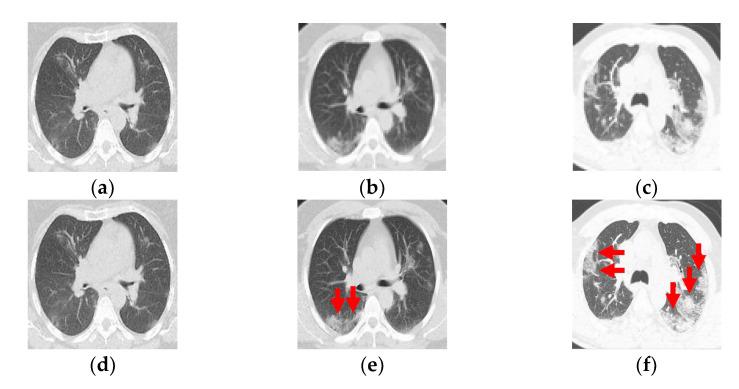 https://cdn.ncbi.nlm.nih.gov/pmc/blobs/0b2c/9227777/c3aca1d2f1a9/tomography-08-00134-g001.jpg