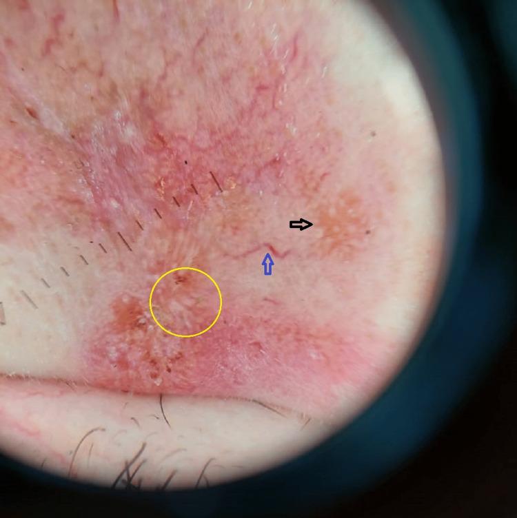 https://cdn.ncbi.nlm.nih.gov/pmc/blobs/0b3b/10039316/15c0b049bb75/cureus-0015-00000035336-i02.jpg