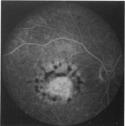 https://cdn.ncbi.nlm.nih.gov/pmc/blobs/0b44/1041061/c9a1993c3019/brjopthal00629-0048-d.jpg