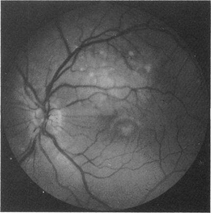 https://cdn.ncbi.nlm.nih.gov/pmc/blobs/0b44/1041061/e590e4d50216/brjopthal00629-0049-c.jpg