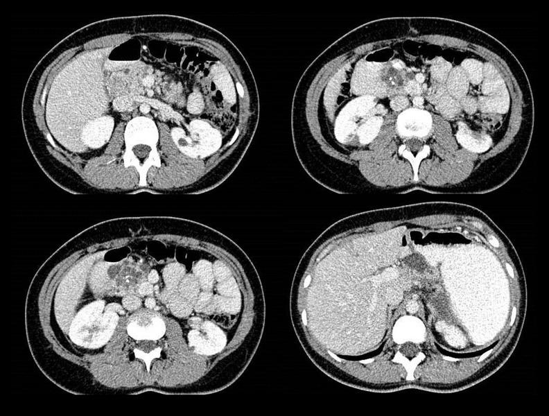 https://cdn.ncbi.nlm.nih.gov/pmc/blobs/0c61/5701459/0359d9d263ce/amjcaserep-18-1220-g001.jpg