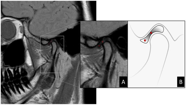 https://cdn.ncbi.nlm.nih.gov/pmc/blobs/0c71/10969375/81cfc813c9be/dentistry-12-00082-g001.jpg