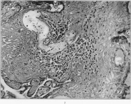 https://cdn.ncbi.nlm.nih.gov/pmc/blobs/0d12/2063417/b37fb532ce96/amjpathol00717-0151-b.jpg