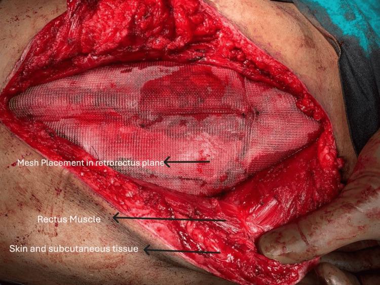 https://cdn.ncbi.nlm.nih.gov/pmc/blobs/0d3b/12199722/7863e8fa9161/cureus-0017-00000084893-i03.jpg