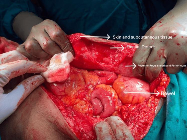 https://cdn.ncbi.nlm.nih.gov/pmc/blobs/0d3b/12199722/8cf1e52b3334/cureus-0017-00000084893-i01.jpg