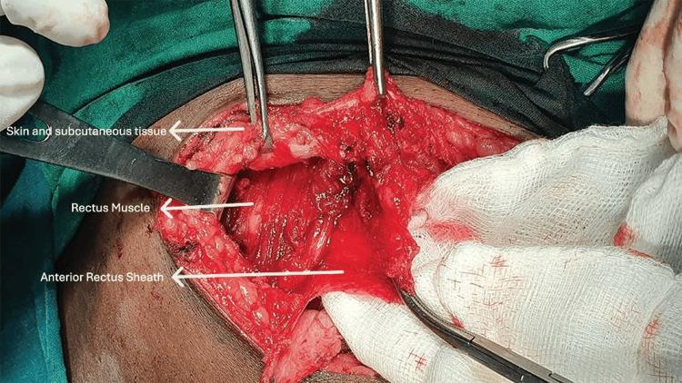 https://cdn.ncbi.nlm.nih.gov/pmc/blobs/0d3b/12199722/9bac48cbfdd3/cureus-0017-00000084893-i04.jpg