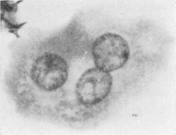 https://cdn.ncbi.nlm.nih.gov/pmc/blobs/0d5d/473616/1875d25a87fd/jclinpath00371-0043-j.jpg