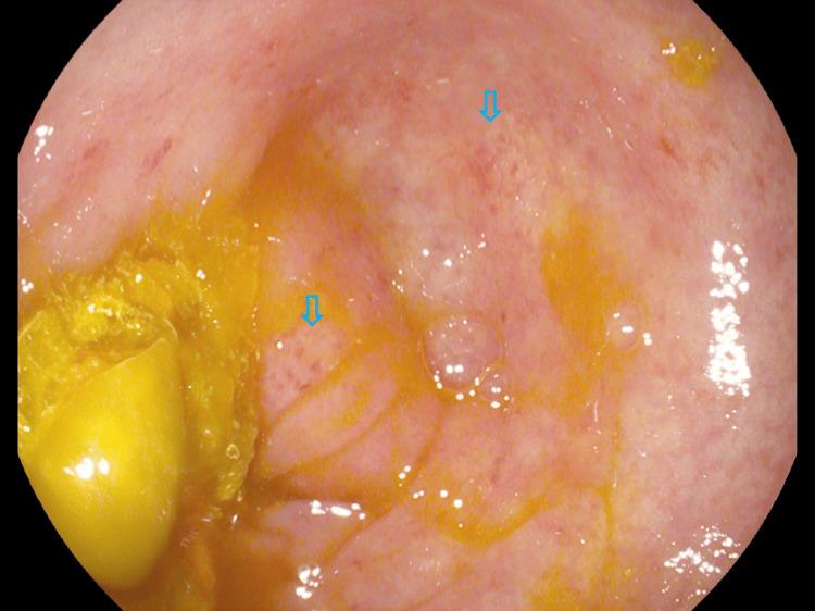 https://cdn.ncbi.nlm.nih.gov/pmc/blobs/0d79/10256567/64edde3d004b/cureus-0015-00000038856-i02.jpg
