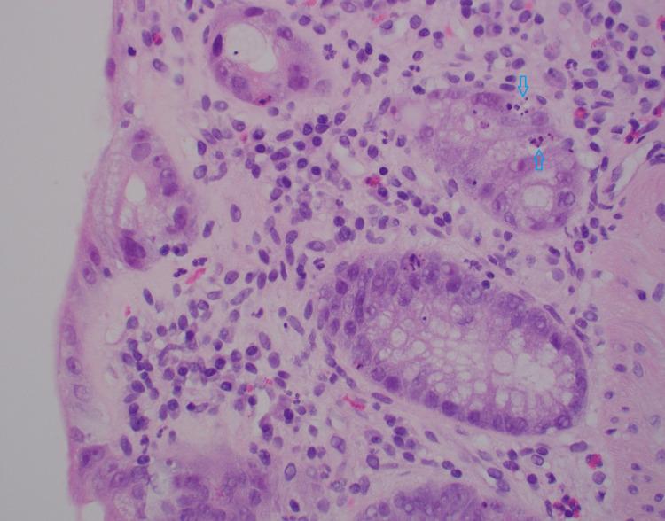 https://cdn.ncbi.nlm.nih.gov/pmc/blobs/0d79/10256567/ff2e100c0386/cureus-0015-00000038856-i04.jpg