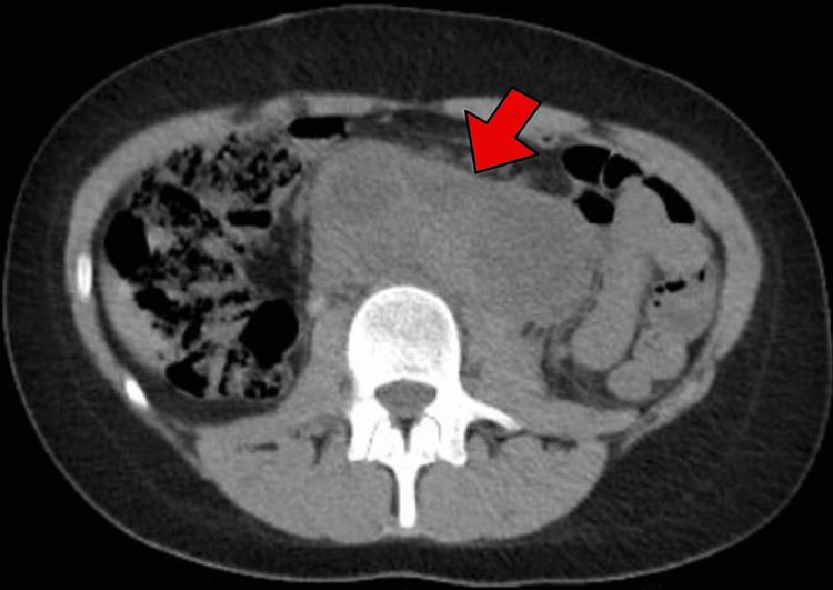 https://cdn.ncbi.nlm.nih.gov/pmc/blobs/0d84/10215025/7d6ce5599269/cureus-0015-00000038149-i02.jpg