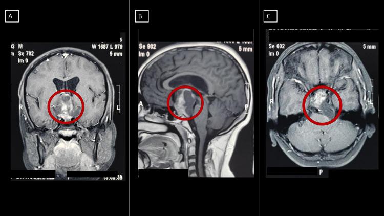 https://cdn.ncbi.nlm.nih.gov/pmc/blobs/0d8f/8591369/6edd0a3df2f9/cureus-0013-00000018814-i01.jpg