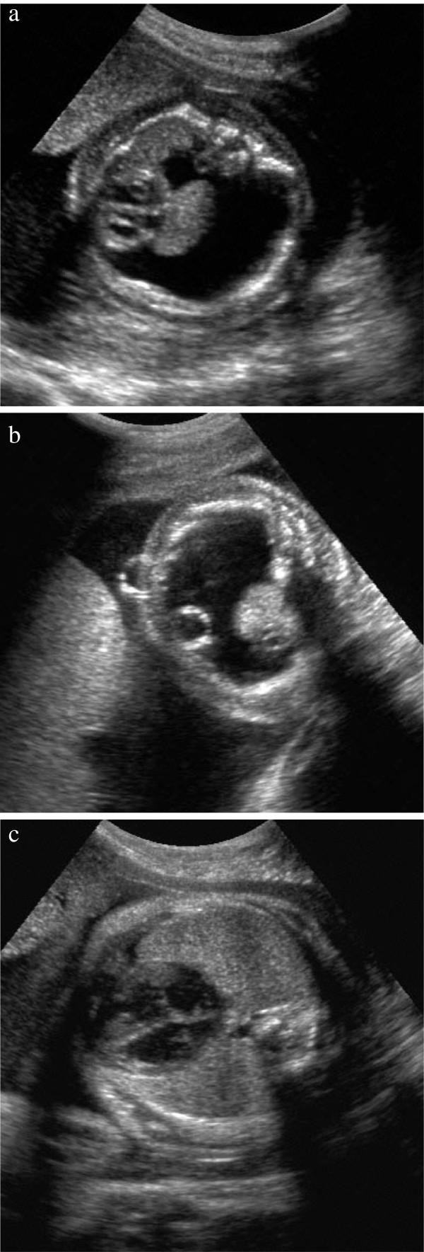https://cdn.ncbi.nlm.nih.gov/pmc/blobs/0dc7/3552949/fd426e1fe093/1750-1172-7-86-1.jpg