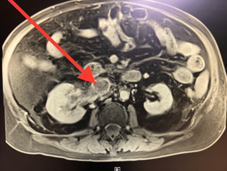 https://cdn.ncbi.nlm.nih.gov/pmc/blobs/0e09/10576161/d13822198f44/cureus-0015-00000045193-i02.jpg
